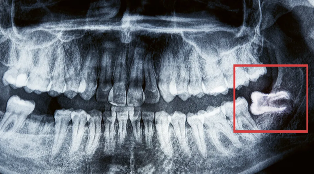 Röntgenkuva hampaista. Poikittain oleva viisaudenhammas on merkitty kuvaan.