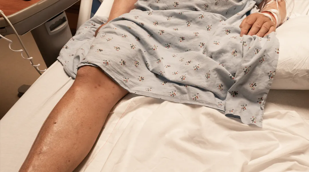 Diabeetikko sairaalasängyssä, jonka jalka on amputoitu.