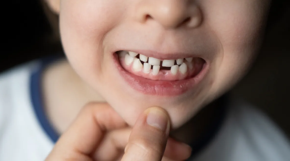 Aikuinen raottaa lapset suuta ja katsoo tämän hampaita. Suussa maitohampaita, joista yksi irronnut.