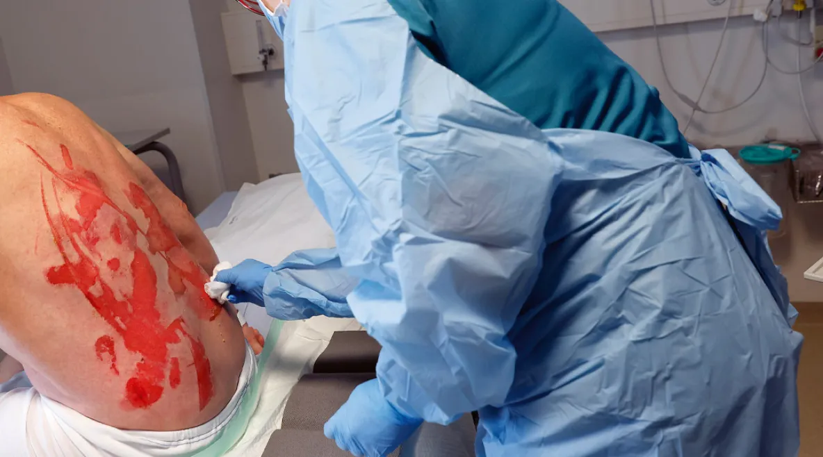 Hoitaja suojavarusteissa hoitamassa potilaan selässä olevia vakavia palovammoja.