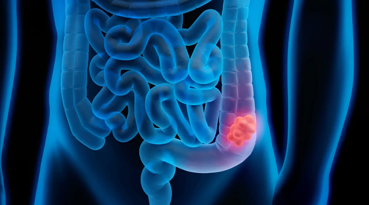 Pirroskuva ihmisen suolistosta, jossa havaittu syöpäkasvain.