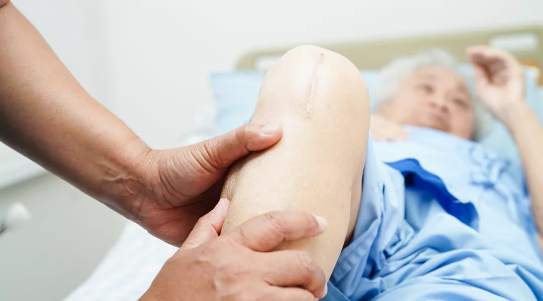 Tunnistamattoman potilaan jalassa näkyy polven tekonivelleikkauksen arpi.