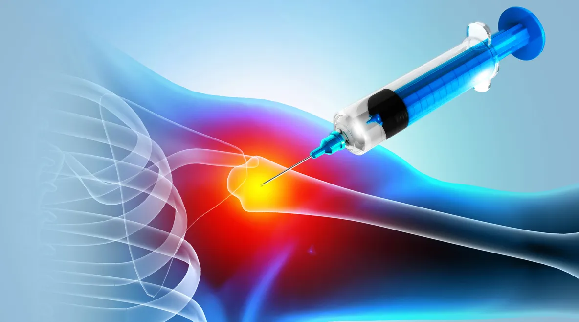 Kuvituskuva olkapäästä, johon pistetään kortisonia.