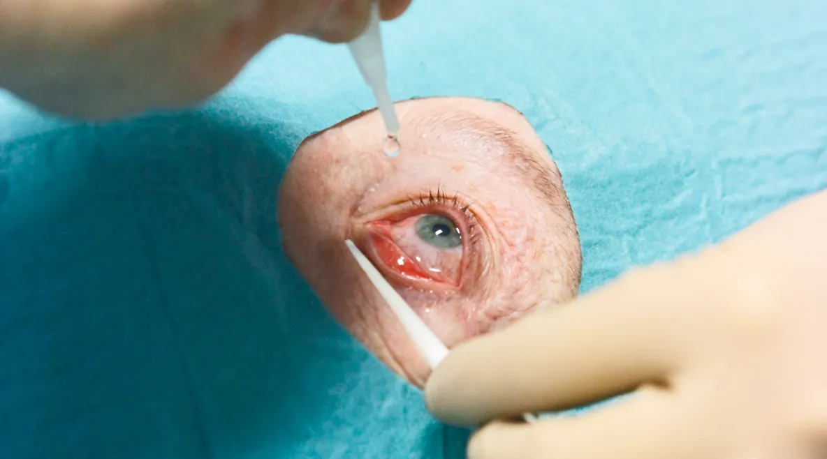 Silmän ympäristö on suojattu leikkausliinalla. Hoitaja tiputtaa silmätippoja ennen injektiota.