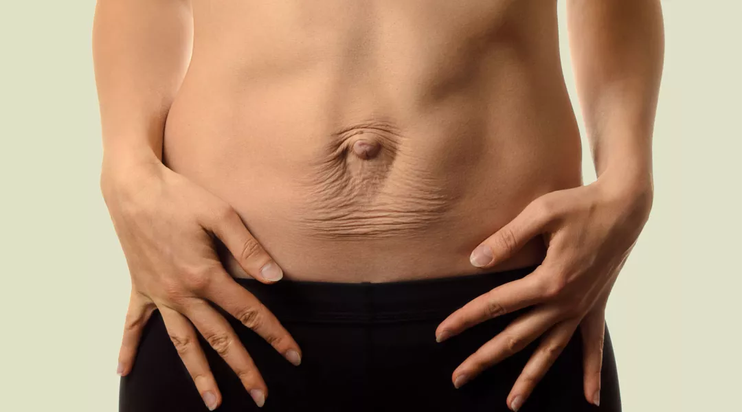 Kuva vatsasta, jossa näkyy vatsalihasten erkauma.