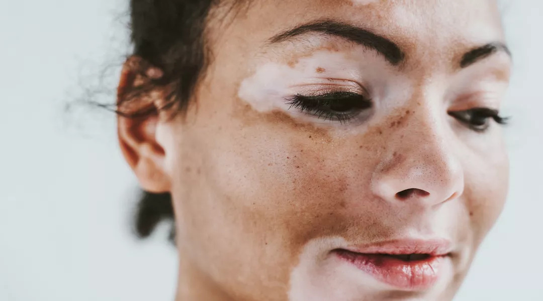 Kuva kasvoista, joissa on vitiligoa.