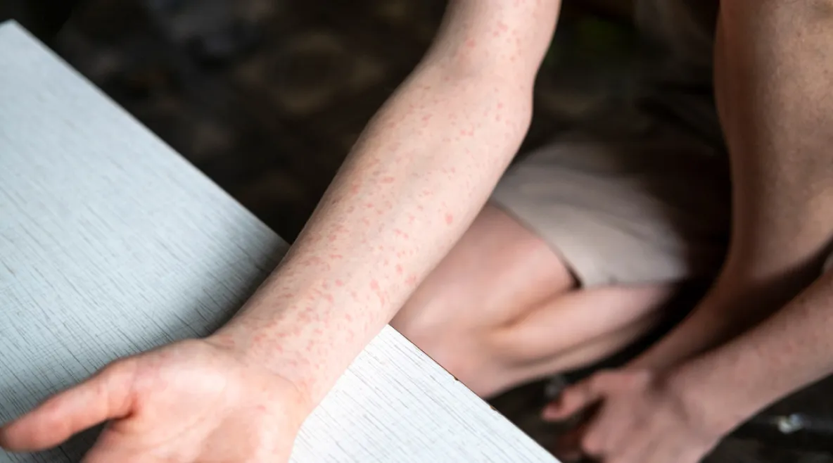 Ruotsissa on käynnissä tuhkarokkoepidemia. Nuoren kädessä tuhkarokkoihottumaa.