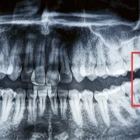 Röntgenkuva hampaista. Poikittain oleva viisaudenhammas on merkitty kuvaan.