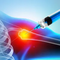 Kuvituskuva olkapäästä, johon pistetään kortisonia.