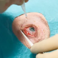 Silmän ympäristö on suojattu leikkausliinalla. Hoitaja tiputtaa silmätippoja ennen injektiota.