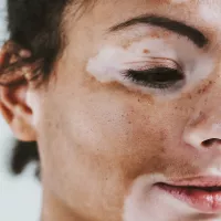 Kuva kasvoista, joissa on vitiligoa.
