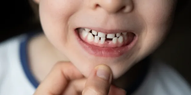 Aikuinen raottaa lapset suuta ja katsoo tämän hampaita. Suussa maitohampaita, joista yksi irronnut.