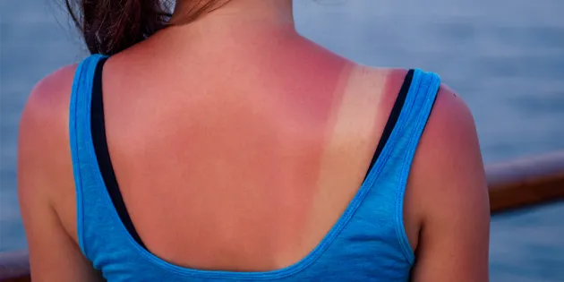 Nuoremmissa ikäryhmissä auringonotto on lisääntynyt. Nuoren selkä, jossa näkyy auringossa palanut selkä ja rusketusrajat.