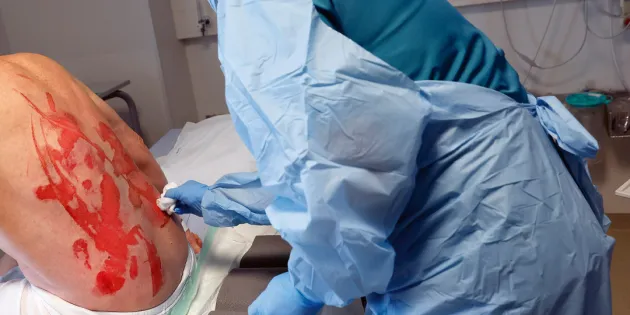 Hoitaja suojavarusteissa hoitamassa potilaan selässä olevia vakavia palovammoja.