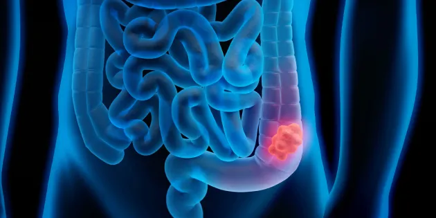 Pirroskuva ihmisen suolistosta, jossa havaittu syöpäkasvain.