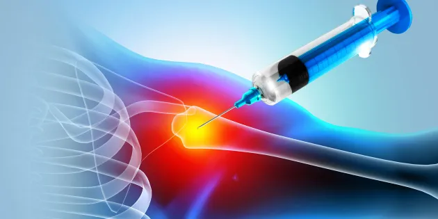 Kuvituskuva olkapäästä, johon pistetään kortisonia.