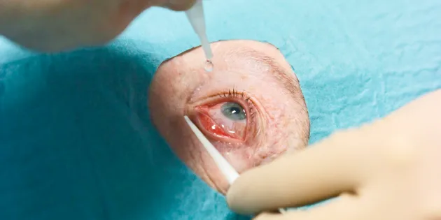 Silmän ympäristö on suojattu leikkausliinalla. Hoitaja tiputtaa silmätippoja ennen injektiota.