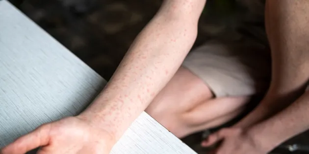 Ruotsissa on käynnissä tuhkarokkoepidemia. Nuoren kädessä tuhkarokkoihottumaa.